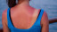Güneş yanığı acısı nasıl geçer? Güneş yanığı tedavisi…